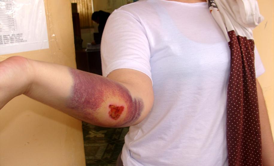 Presa mostra ferimentos provocados durante a rebelião na Penitenciária Feminina do Paraná.